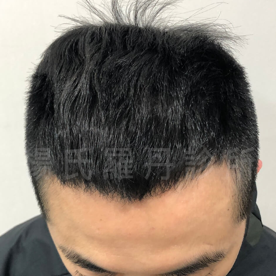 禿頭 生髮 複合式生髮 掉髮 六合一三階段雄性禿治療